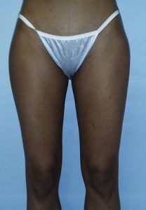 Thigh Liposuction After Results