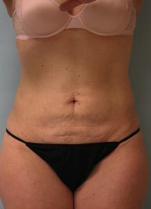 Abdomen Liposuction After