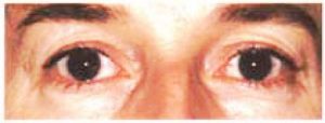 Eyelid Surgery - Upper Blepharoplasty Before