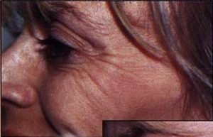 Botox Before Wrinkles