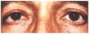 Eyelid Surgery - Upper Blepharoplasty After Male Patient
