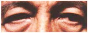 Eyelid Surgery - Upper Blepharoplasty Before Male Patient