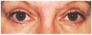 Eyelid Surgery - Upper Blepharoplasty After
