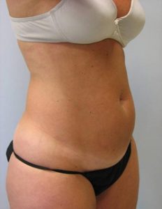 Abdomen Liposuction Before