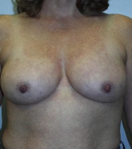 Liposuction - Breast Reduction After Results