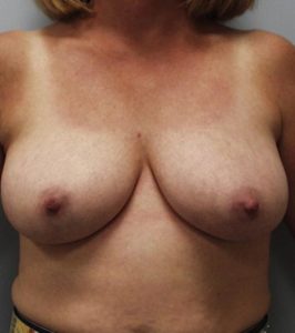 Liposuction - Breast Reduction Before