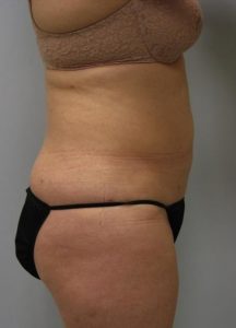 Belly Liposuction After