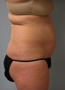 Belly Liposuction Before