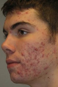 Non-Surgical - Acne Treatment in Seattle Before