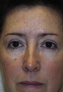 Eyelid Surgery - Upper Blepharoplasty After