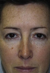 Eyelid Surgery - Upper Blepharoplasty Before