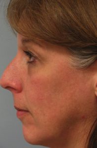 Skin Rejuvenation CO2 Laser Resurfacing After