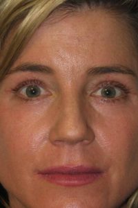 Eyelid Surgery - Upper Blepharoplasty Before After