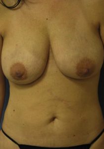 Liposuction - Breast Reduction Before Results