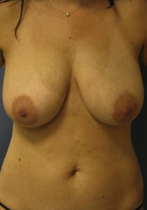 Liposuction - Breast Reduction Before