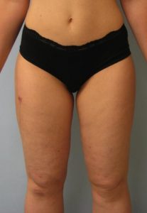 Thigh Liposuction After