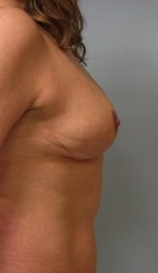 Liposuction - Breast Reduction After Results