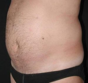 Non-Surgical - UltraShape Before Seattle Male Patient