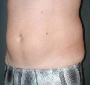 Non-Surgical - UltraShape After Seattle Male Patient