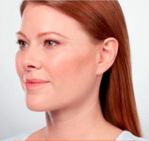 Non-Surgical - Kybella After